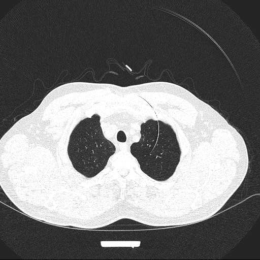 File:Allergic bronchopulmonary aspergillosis (Radiopaedia 21386-21320 Axial lung window 4).jpg
