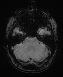 File:Alzheimer's disease- with Gerstmann syndrome and dressing apraxia (Radiopaedia 54882-61150 Axial SWI 8).png