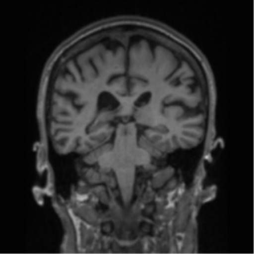 File:Alzheimer's disease- with apraxia (Radiopaedia 54763-61011 Coronal T1 41).png