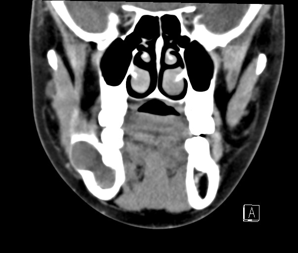 File:Ameloblastoma (Radiopaedia 26645-26793 Coronal C+ delayed 2).jpg