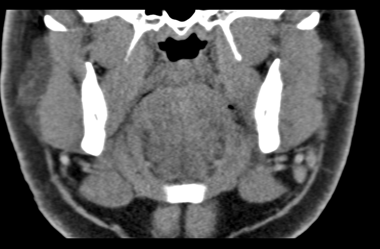 Ameloblastoma (Radiopaedia 33677-34806 Coronal non-contrast 33).png