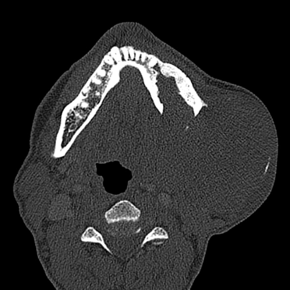 Ameloblastoma (Radiopaedia 51921-57766 Axial bone window 56).jpg