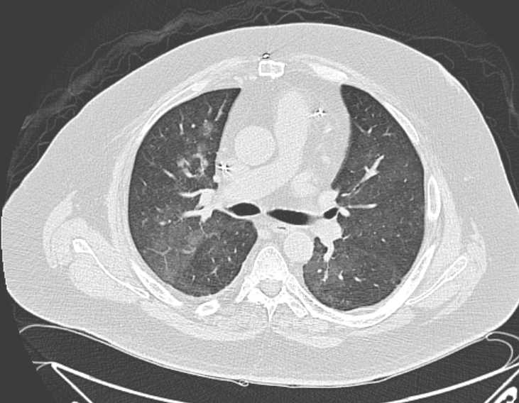 Amiodarone lung (Radiopaedia 62514-70769 Axial lung window 39).jpg