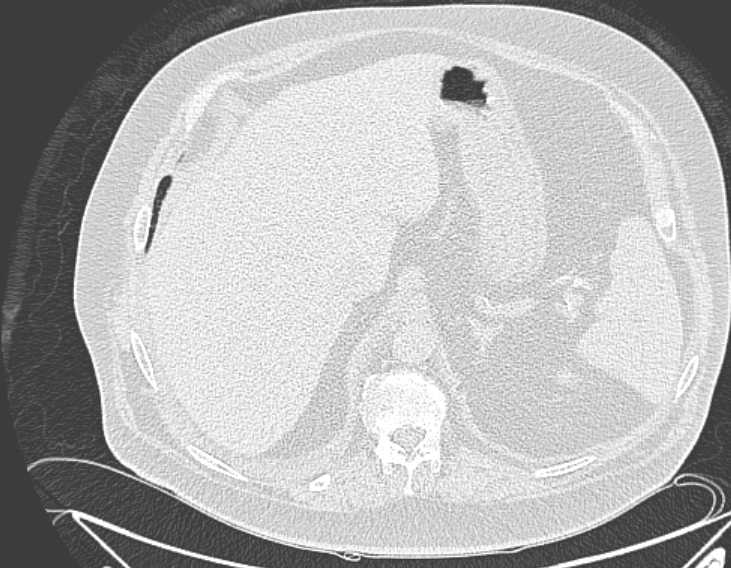 File:Amiodarone lung (Radiopaedia 62514-70769 Axial lung window 82).jpg