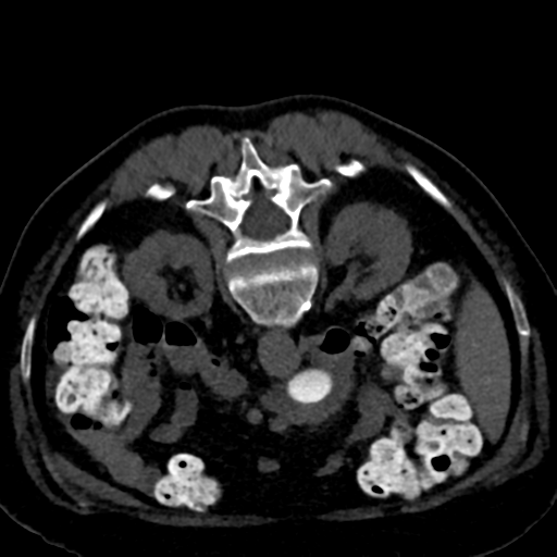 Ampullary adenocarcinoma (Radiopaedia 34013-35241 C 47).png