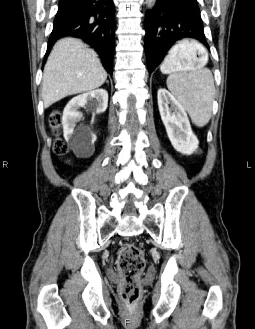 Ampullary adenocarcinoma (Radiopaedia 86093-102032 C 51).jpg