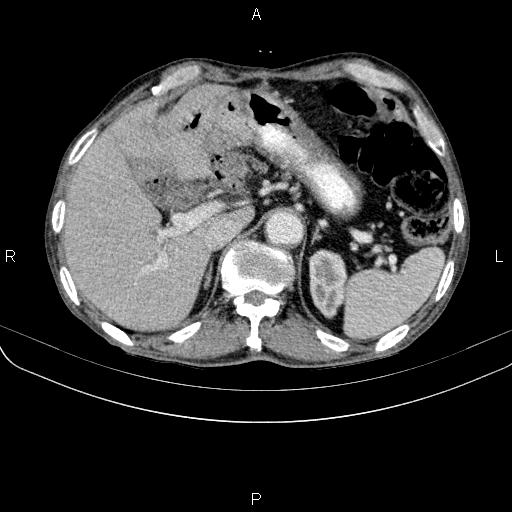 Ampullary adenocarcinoma (Radiopaedia 86093-102033 B 55).jpg