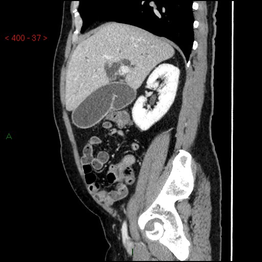 Ampullary carcinoma (Radiopaedia 56396-63056 D 36).jpg
