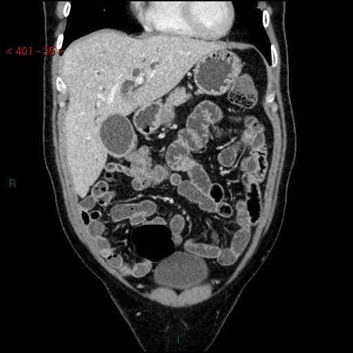 Ampullary carcinoma (Radiopaedia 56396-63056 E 34).jpg
