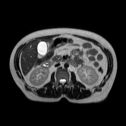File:Ampullary tumor (Radiopaedia 27294-27479 T2 4).jpg