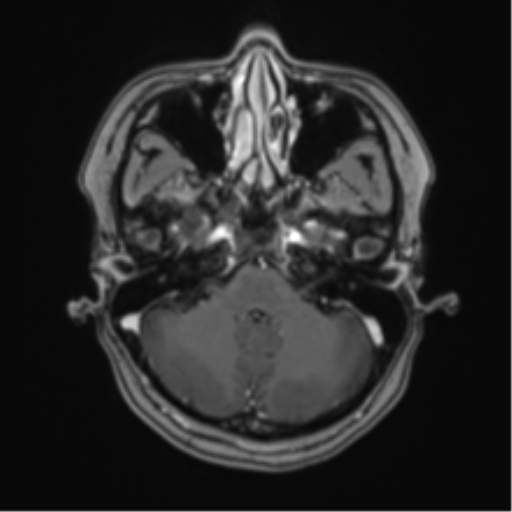 Anaplastic astroblastoma (Radiopaedia 55666-62194 Axial T1 C+ 17).png