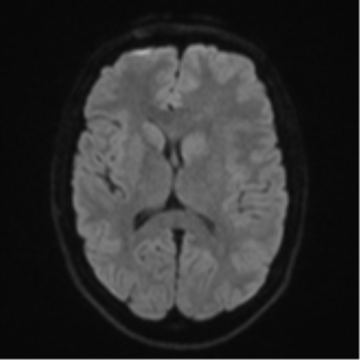 Anaplastic astrocytoma (Radiopaedia 57768-64731 Axial DWI 43).png