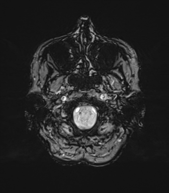 File:Anaplastic astrocytoma (Radiopaedia 86943-103160 Axial SWI 12).png