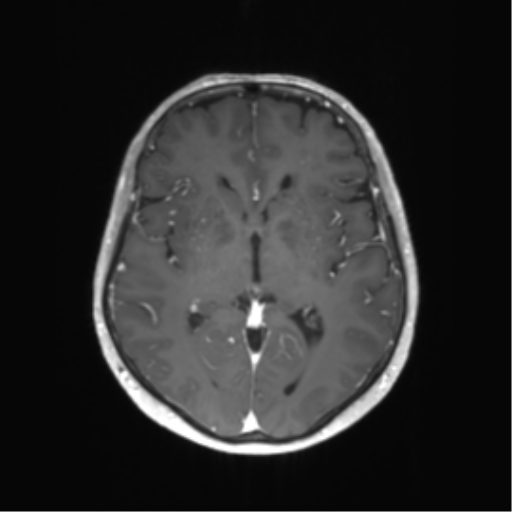 File:Anaplastic astrocytoma (Radiopaedia 86943-103160 Axial T1 C+ 26).png