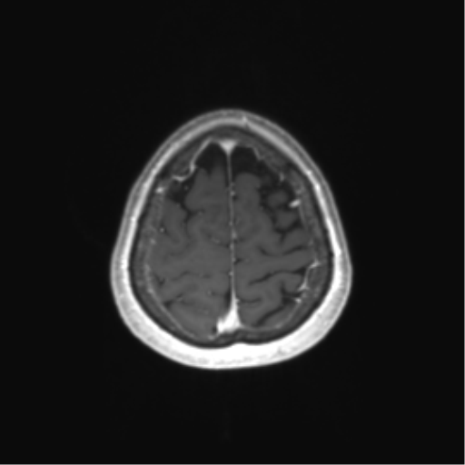 File:Anaplastic astrocytoma (Radiopaedia 86943-103160 Axial T1 C+ 79).png