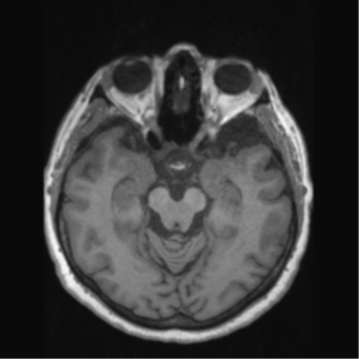 Anaplastic astrocytoma IDH wild-type (pseudoprogression) (Radiopaedia 42209-45276 Axial T1 63).png