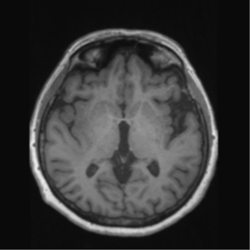 Anaplastic astrocytoma IDH wild-type (pseudoprogression) (Radiopaedia 42209-45276 Axial T1 78).png