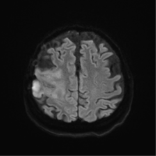 Anaplastic astrocytoma IDH wild-type (pseudoprogression) (Radiopaedia 42209-45279 Axial DWI 47).png
