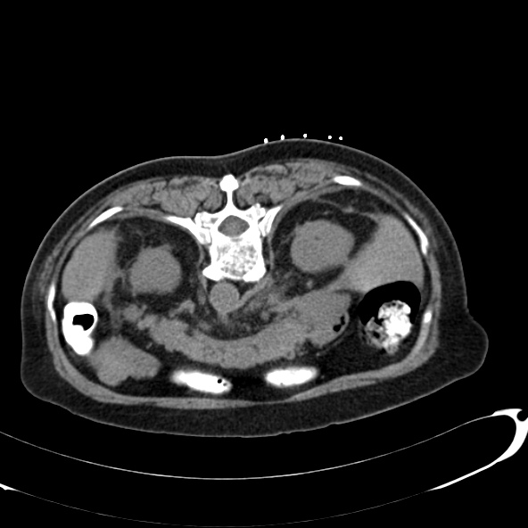 Anaplastic lymphoma - with CT biopsy (Radiopaedia 21643-21602 Axial non-contrast 16).jpg