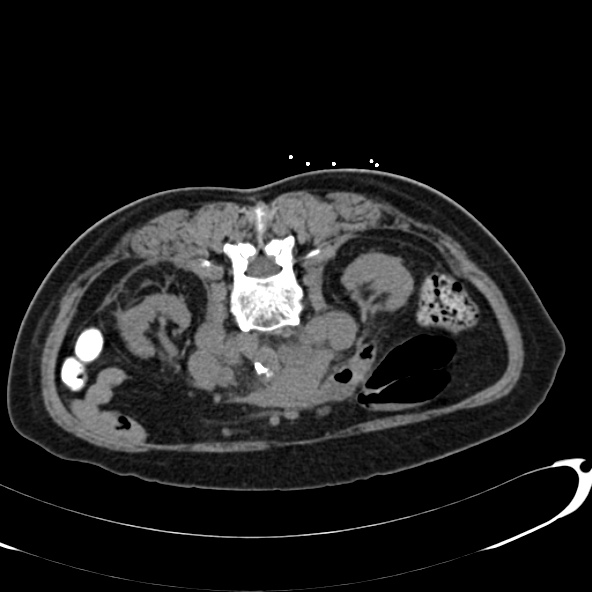 File:Anaplastic lymphoma - with CT biopsy (Radiopaedia 21643-21602 Axial non-contrast 32).jpg