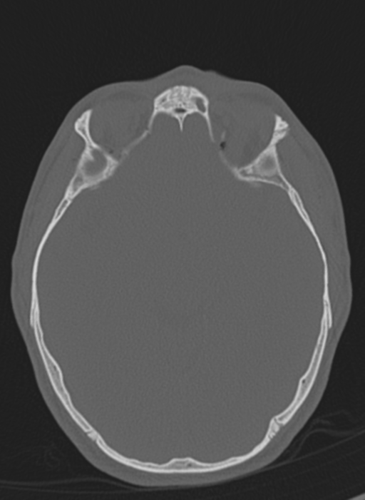 Anaplastic oligodendroglioma with skull fracture (Radiopaedia 74831-85846 Axial bone window 41).png