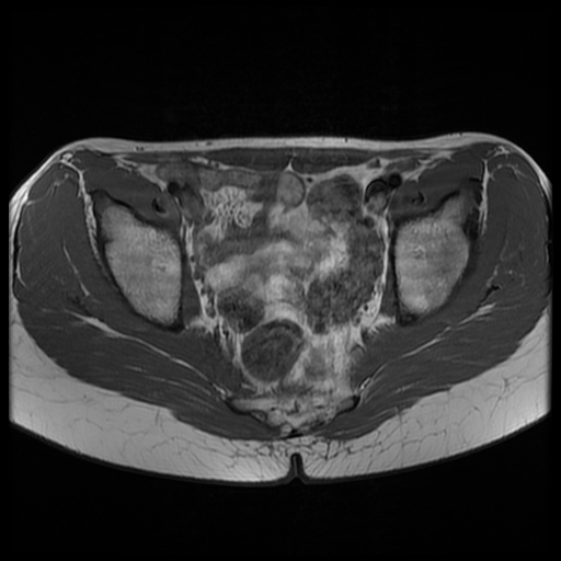 File:Androgen insensitivity syndrome (Radiopaedia 38585-40727 Axial T1 13).jpg