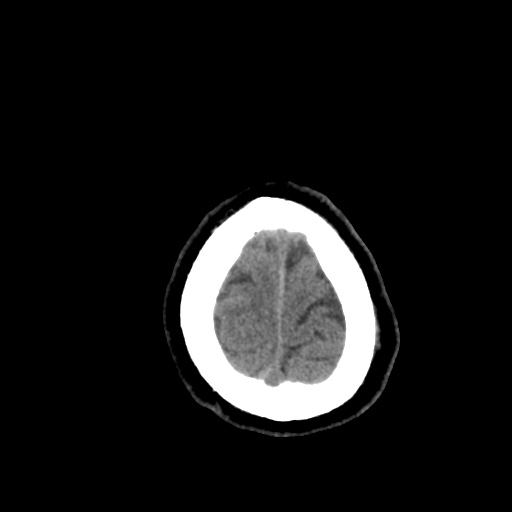 Aneursym related subarachnoid hemorrhage with hydrocephalus (Radiopaedia 45105-49085 Axial non-contrast 48).jpg