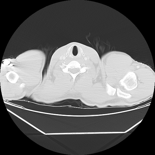 Aneurysmal bone cyst - rib (Radiopaedia 82167-96220 Axial lung window 3).jpg