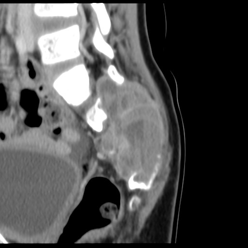 File:Aneurysmal bone cyst - sacrum (Radiopaedia 65190-74195 A 20).jpg