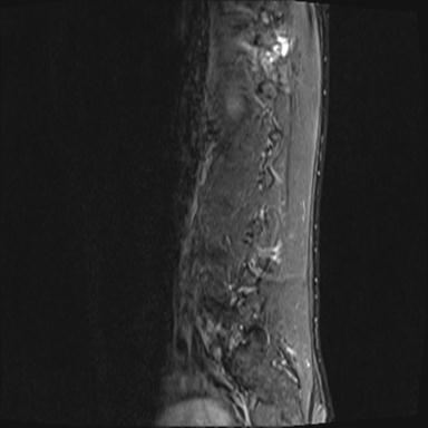 File:Aneurysmal bone cyst T11 (Radiopaedia 29294-29720 Sagittal STIR 14).jpg