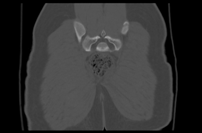File:Aneurysmal bone cyst of ischium (Radiopaedia 25957-26094 Coronal bone window 41).png