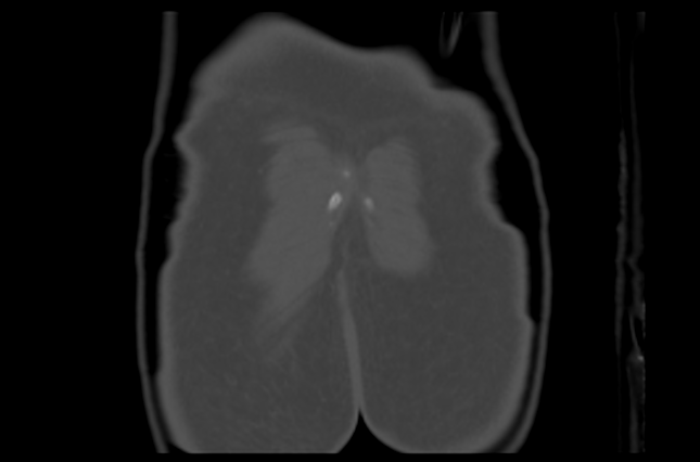 File:Aneurysmal bone cyst of ischium (Radiopaedia 25957-26094 Coronal bone window 48).png