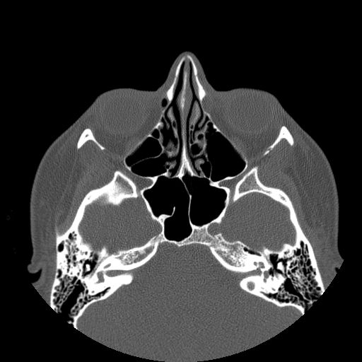 Aneurysmal bone cyst of the mandible (Radiopaedia 43280-46823 Axial bone window 156).jpg