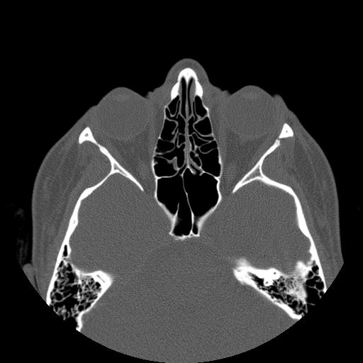 Aneurysmal bone cyst of the mandible (Radiopaedia 43280-46823 Axial bone window 167).jpg