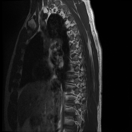 File:Angiolipoma - thoracic spine (Radiopaedia 28242-28479 Sagittal T1 13).jpg