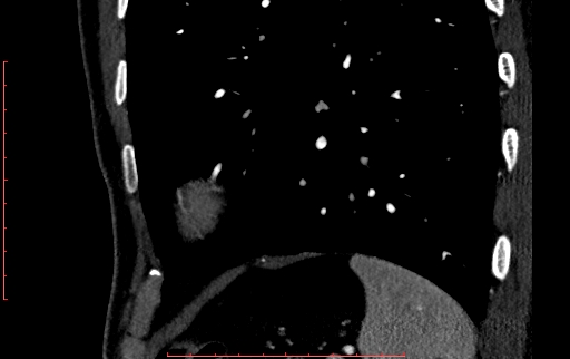 Anomalous left coronary artery from the pulmonary artery (ALCAPA) (Radiopaedia 70148-80181 C 264).jpg