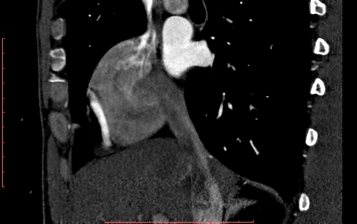 Anomalous left coronary artery from the pulmonary artery (ALCAPA) (Radiopaedia 70148-80181 C 34).jpg