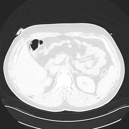 File:Anomalous origin of the left coronary artery with malignant course (Radiopaedia 77842-90126 Axial lung window 39).jpeg