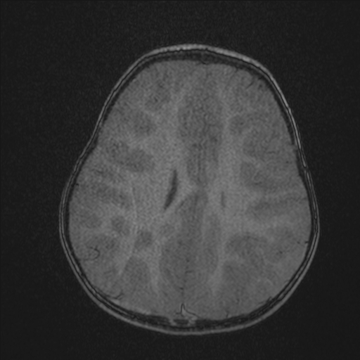Anoxic brain injury (Radiopaedia 79165-92139 Axial MRA 175).jpg