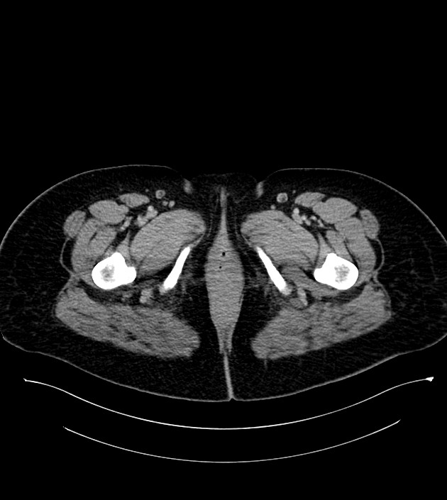 Anterior abdominal wall CSF pseudocyst (CSFoma) (Radiopaedia 79453-92571 A 99).jpg