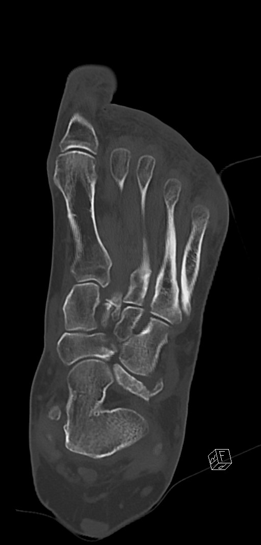Anterior calcaneal process fracture (Radiopaedia 63353-71943 Coronal bone window 25).jpg
