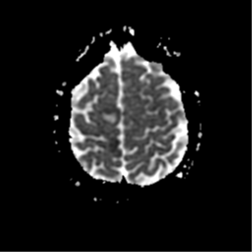 File:Anterior cerebral artery territory infarct (Radiopaedia 39327-41584 Axial ADC 22).png