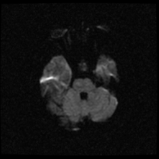 File:Anterior cerebral artery territory infarct (Radiopaedia 39327-41584 Axial DWI 7).png