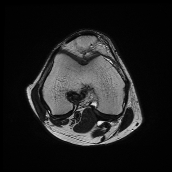 File:Anterior cruciate ligament graft tear and bucket-handle tear of medial meniscus (Radiopaedia 75867-87254 Axial T2 15).jpg