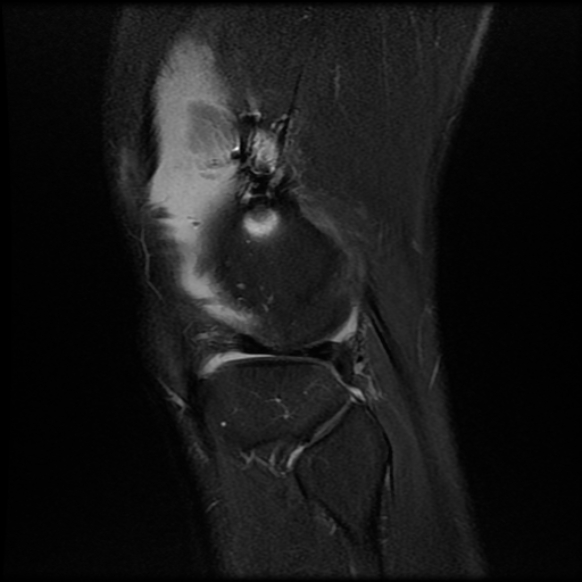 File:Anterior cruciate ligament graft tear and bucket-handle tear of medial meniscus (Radiopaedia 75867-87255 Sagittal PD fat sat 24).jpg