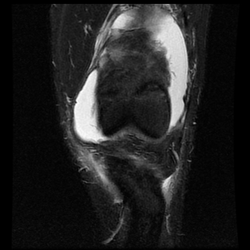 File:Anterior cruciate ligament tear (Radiopaedia 61500-69462 Coronal STIR 6).jpg