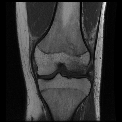 File:Anterior cruciate ligament tear (Radiopaedia 61500-69462 Coronal T1 11).jpg