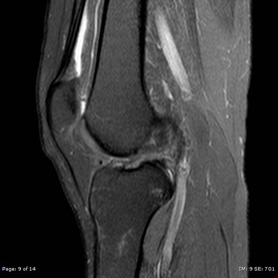 File:Anterior cruciate ligament tear (Radiopaedia 70783-80964 Sagittal PD fat sat 9).jpg