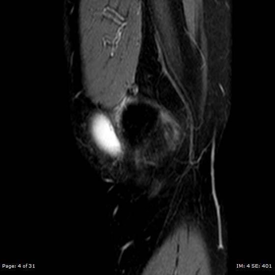 File:Anterior cruciate ligament tear (Radiopaedia 70783-80964 Sagittal STIR 4).jpg
