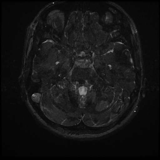 Anterior inferior cerebellar artery vascular loop - type II (Radiopaedia 70991-81209 Axial 3D FIESTA 3).jpg